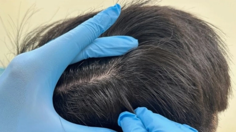 Tóc Sâu Nữ: Nguyên Nhân, Dấu Hiệu Nhận Biết và Cách Khắc Phục Hiệu Quả